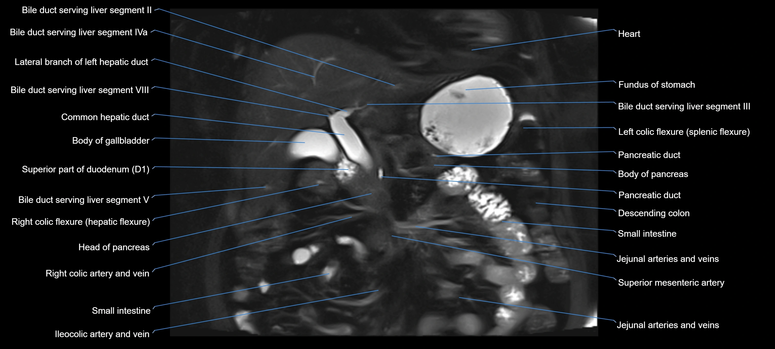 MRI MRCP coronal cross sectional 3T radiology  image-img-00001-00010.webp